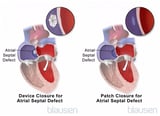 Atrial and Ventricular Septal Defects