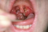 Tonsillopharyngitis