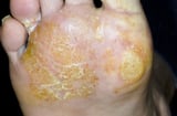 Hand and Foot Dermatitis