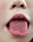 Tongue Discoloration and Other Changes