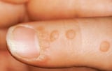 Overview of Nail Disorders - Skin Disorders - MSD Manual Consumer Version