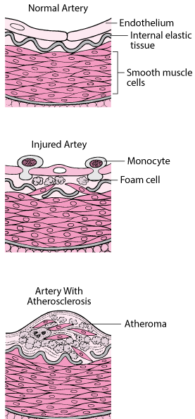 How Atherosclerosis Develops