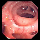 Diverticulosis of the Large Intestine