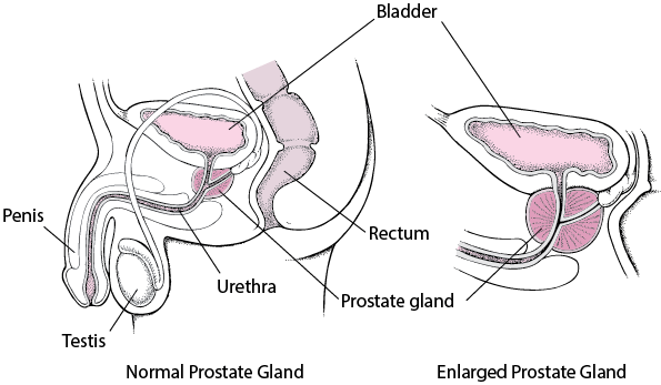 normal size of prostate gland)