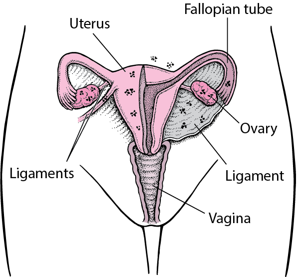 Endometriosis: Misplaced Tissue