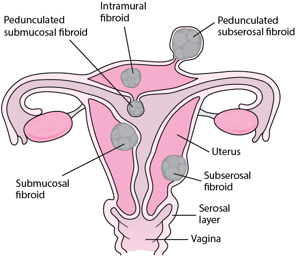 Where Fibroids Grow