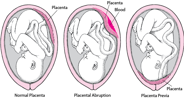Problems With the Placenta