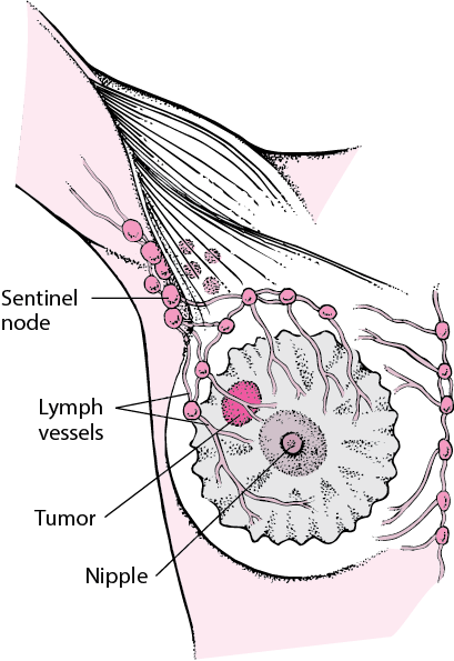 What Is a Sentinel Lymph Node?