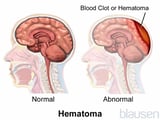 Subdural Hematomas