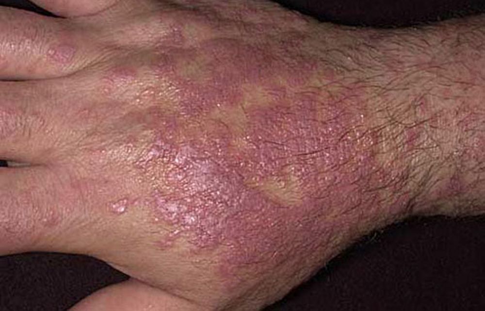 Lichen Planus - Skin Disorders - MSD Manual Consumer Version