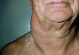 Some Causes and Features of Swollen Lymph Nodes