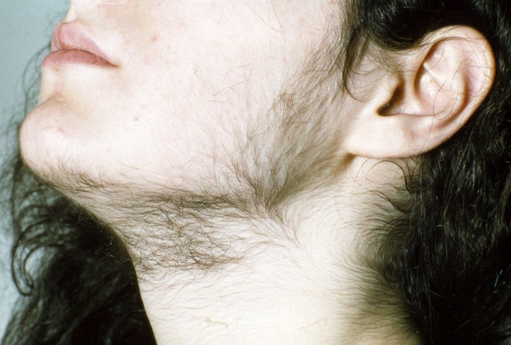 Hairiness - Skin Disorders - MSD Manual Consumer Version