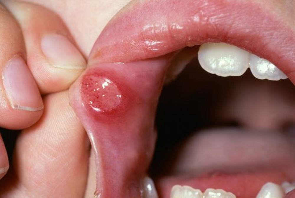 Recur Aphthous Stomatitis Mouth