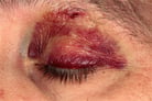 Blunt Eye Injuries