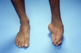 Pes planus (flat feet)