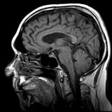 Diffusion-weighted MRI