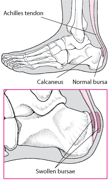 Bursitis in the Heel