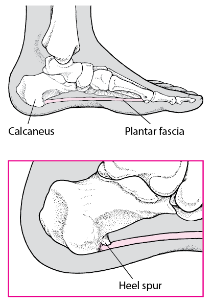 Plantar Fasciosis - Bone, Joint, and Muscle Disorders - MSD Manual ...