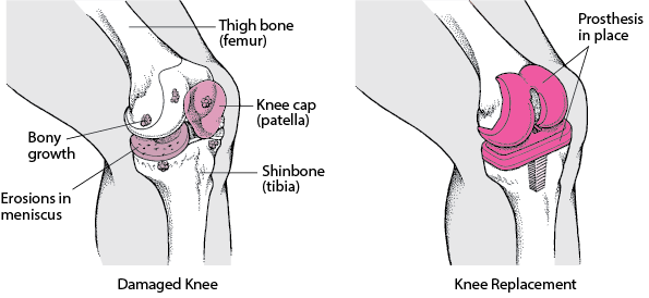 Replacing a Knee