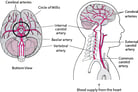 Overview of Stroke