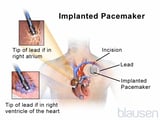 Artificial Pacemakers