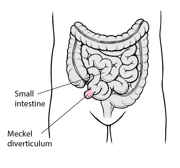 Meckel Diverticulum Children S Health, White Mucus In Stool Hindi Meaning