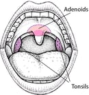 Enlarged Tonsils and Adenoids