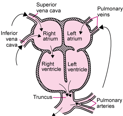 Persistent Truncus Arteriosus
