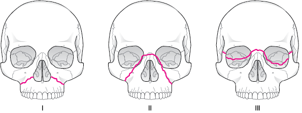 Fractures of the Midface