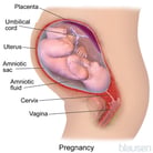 Intra-Amniotic Infection