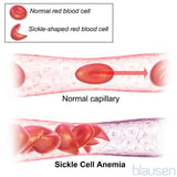 Sickle cell crisis