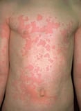 Overview of Allergic Reactions