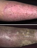 Chronic Venous Insufficiency and Post-Thrombotic Syndrome