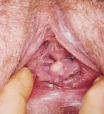 Vulvar Inclusion and Epidermal Cysts