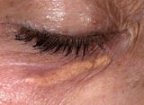 Basal cell carcinoma of the eye