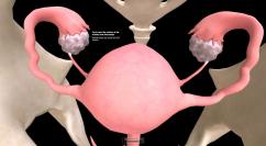 Sindrome dell’ovaio policistico