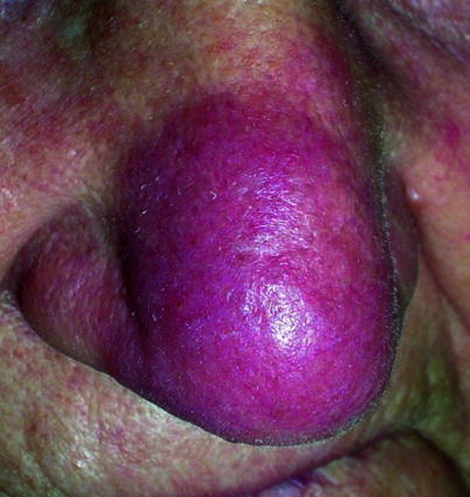 Lupus pernio