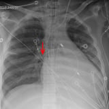 Pulmonary artery occlusion pressure (pulmonary artery wedge pressure)