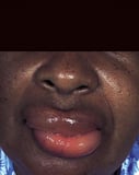 Lip Swelling
