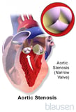 Types of Severe Aortic Stenosis