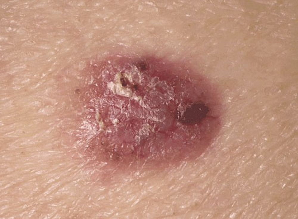 Multiple basal cell papillomas Skin Cancer Bowen's Disease Appearance papilloma colon