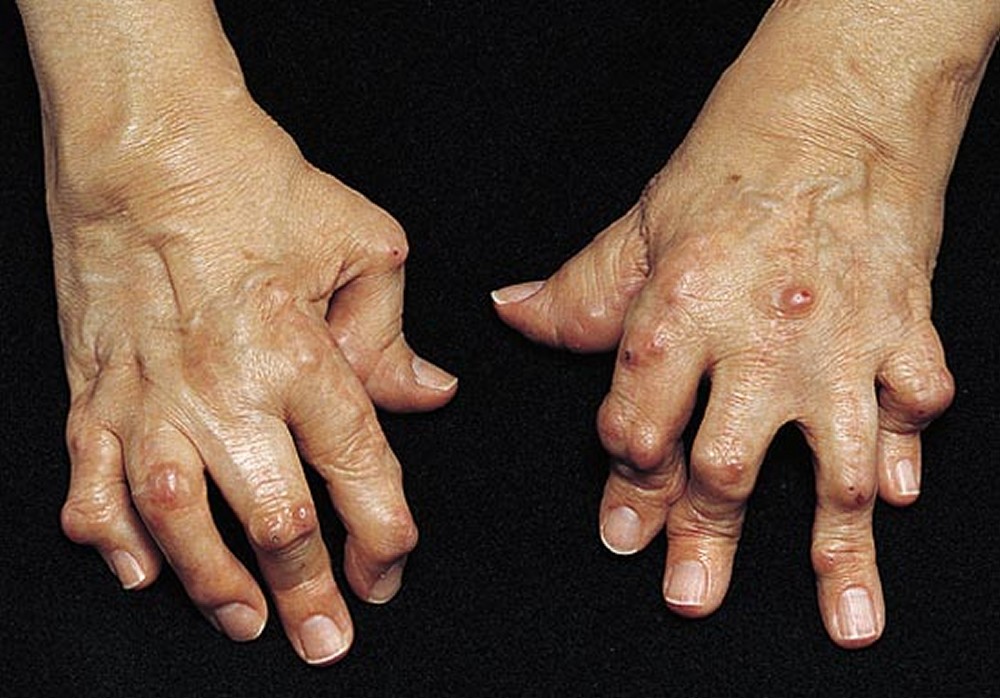 reumás és rheumatoid arthritis)