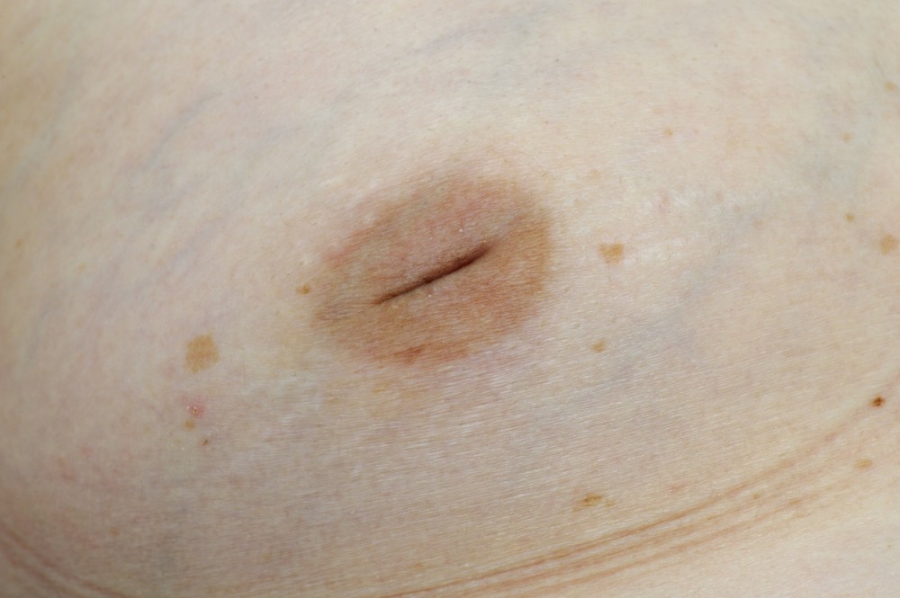 Male on nipple white bump Are Bumps