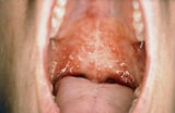 Some Causes of Stomatitis