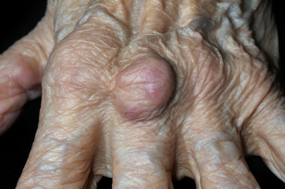 A lábak ízületei zsibbadnak - Reumatoid arthritis
