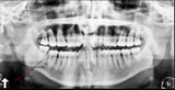 Fractures of the Mandible and Midface