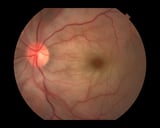 Central Retinal Artery Occlusion and Branch Retinal Artery Occlusion