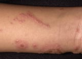 Allergic contact dermatitis (ACD)