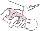 How To Treat the Choking Conscious Infant