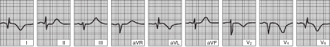 Lateral left ventricular infarction (several days later)